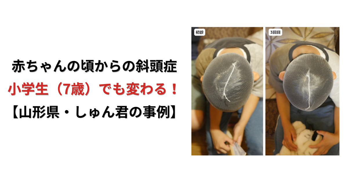 赤ちゃんの頃からの斜頭症・頭の歪みは小学生からでも変わる？7歳（小2）男の子の改善例。あかとき庵