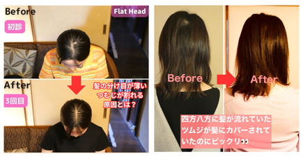 頭の形がつむじ割れや髪の分け目の薄さに影響