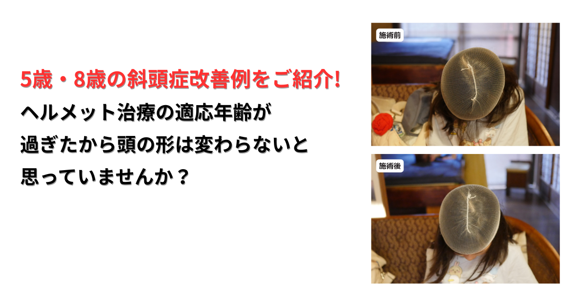 【5歳・8歳の斜頭症（女の子）改善症例】｜韓国在住で諦めかけていた頭の形が変化した理由